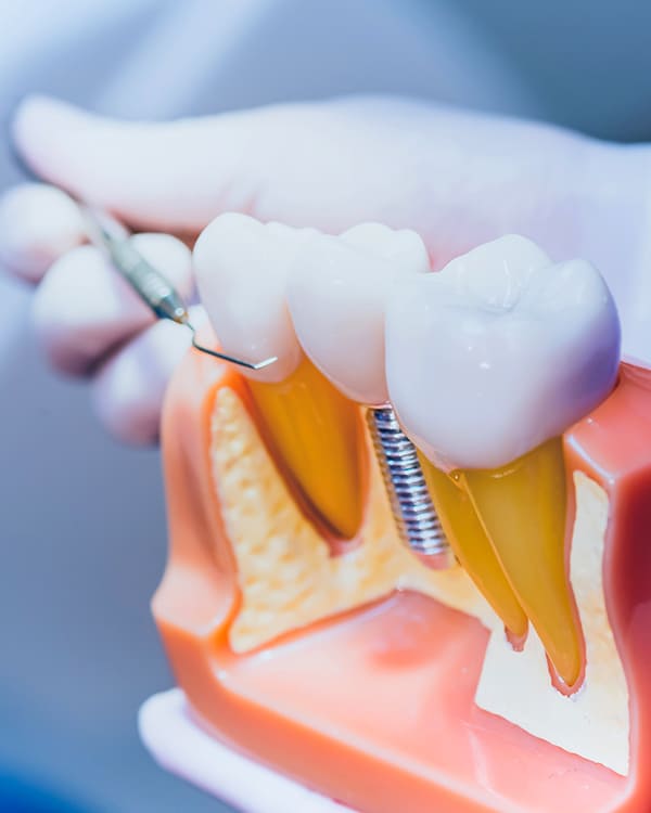 Dentist Implants
